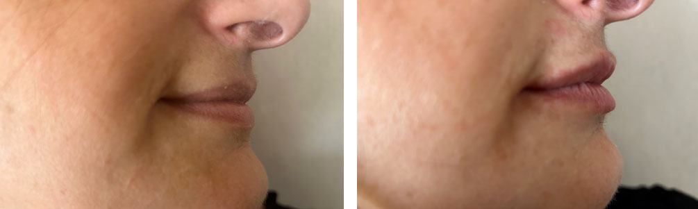 trattamento modellamento labbra marigliano